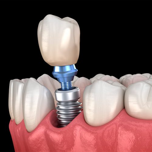 implante-dentario-1